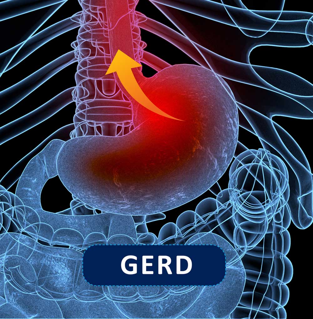 46 Gastroesophageal Reflux Disease Or Gerd Background GERD