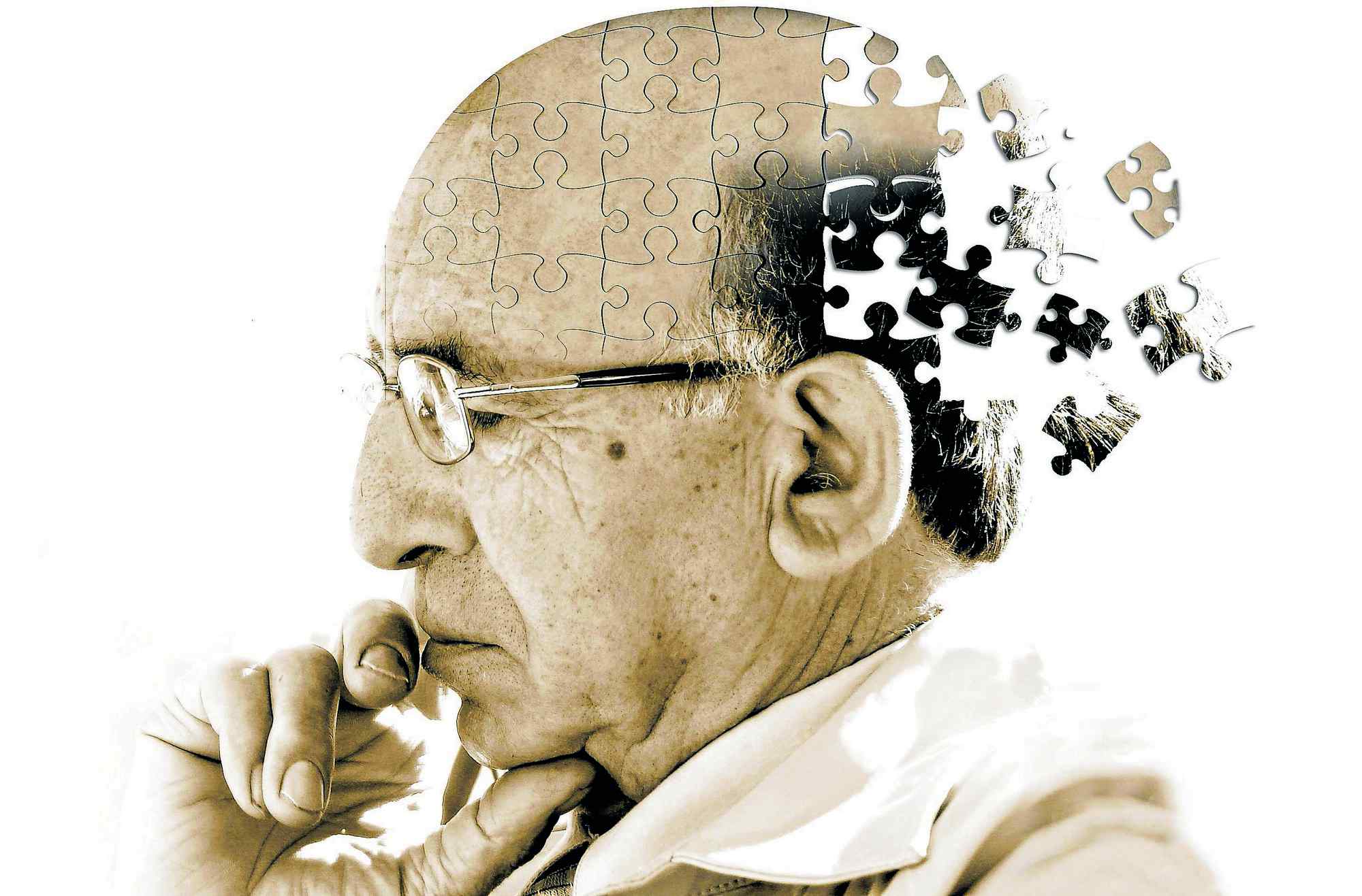 Man with Alzheimer's Disease and missing puzzle peices on his head