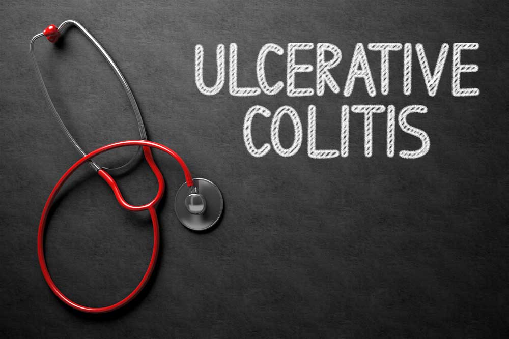 Ulcerative Colitis Research