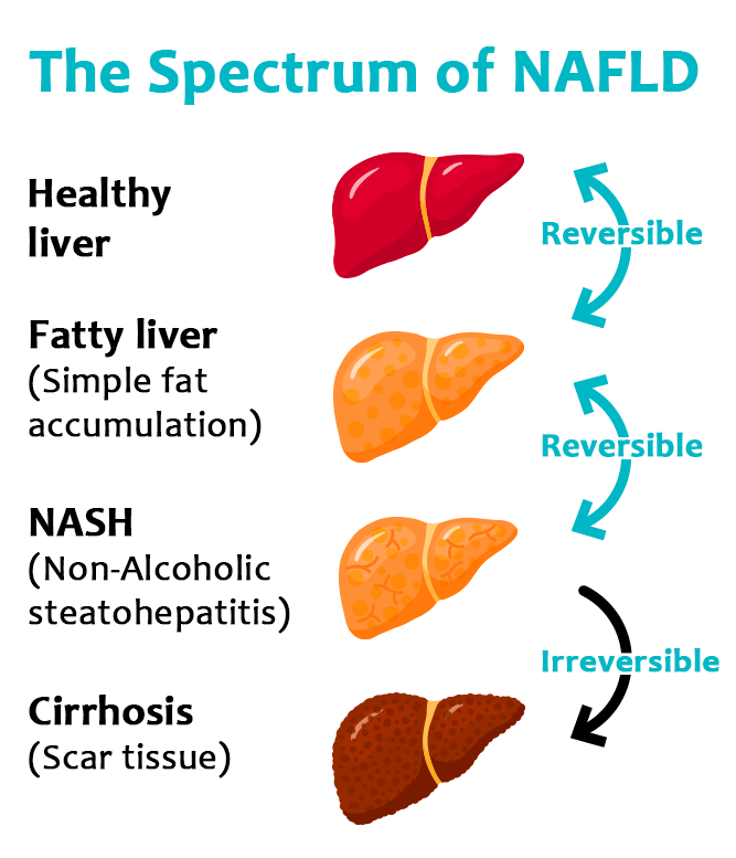 The Spectrum of NAFLD Fatty Liver Disease NASH