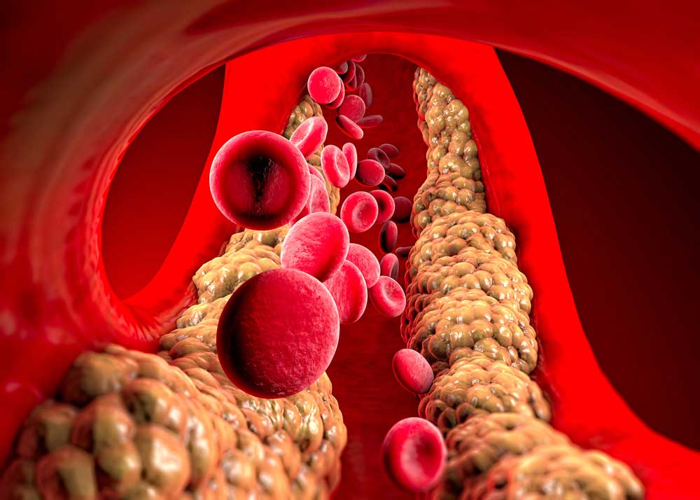 Understanding and Managing High Triglycerides