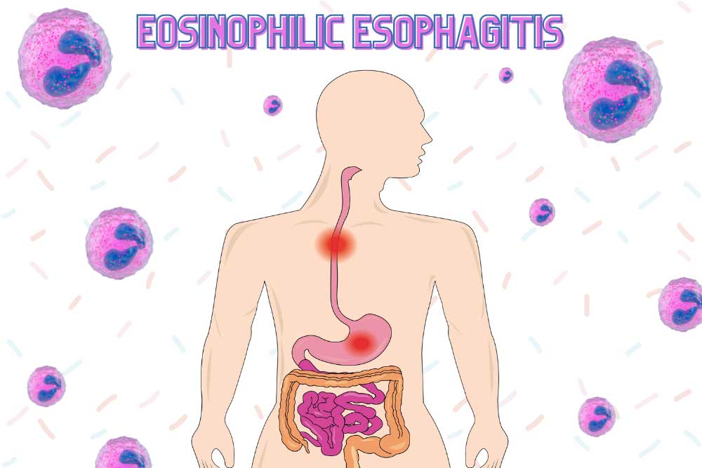 When Good Eosinophils Go Bad