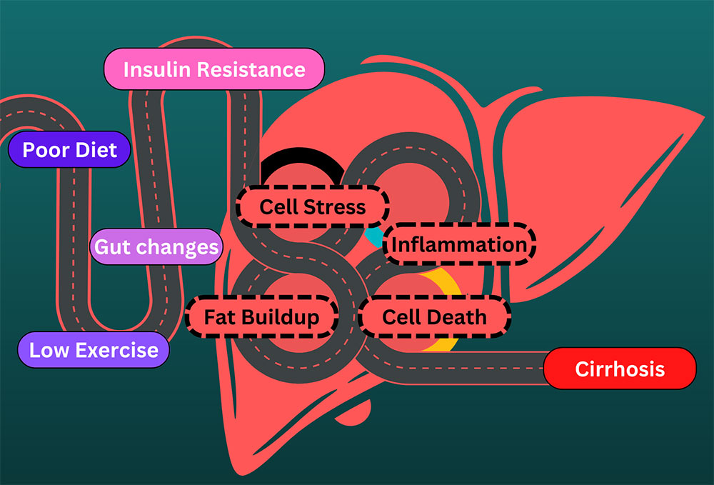 Fatty-Liver-NASH-Cirrhosis-Progression.jpg