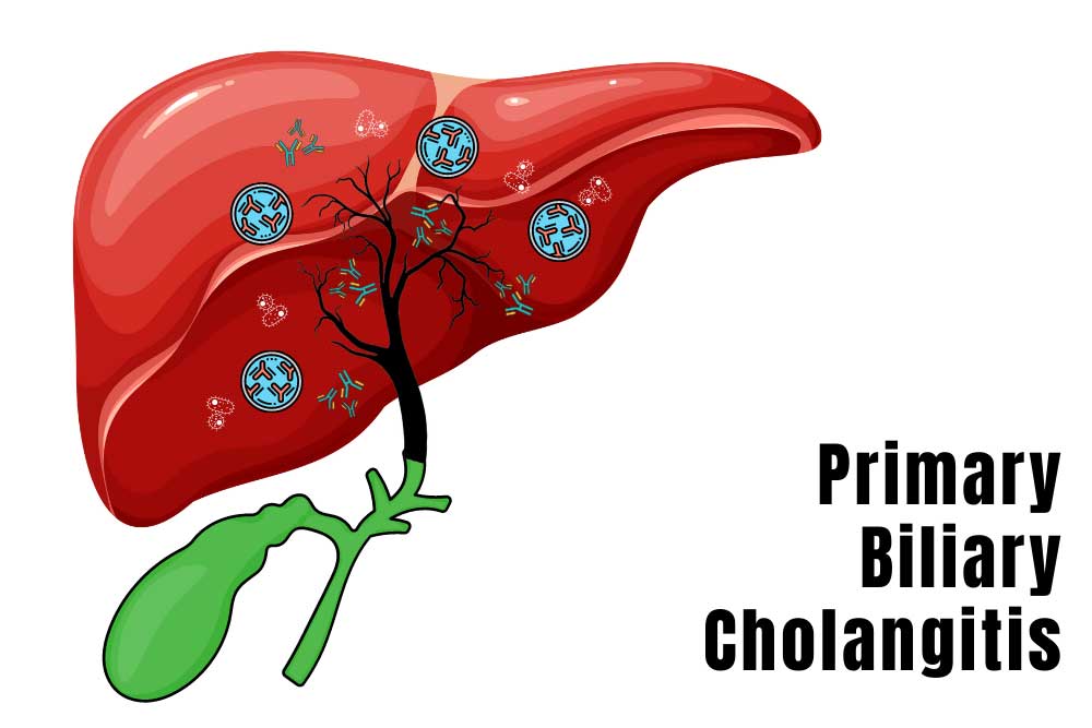 Primary-Biliary-Cholangitis-1.jpg