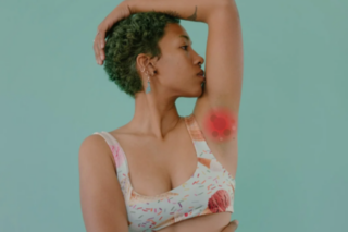 Hidradenitis Suppurativa