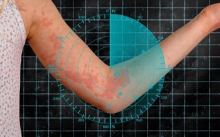 What a Cold War Hero Can Teach Us About Chronic Hives