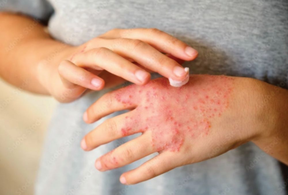 Atopic-Dermatitis-Study-1.jpg